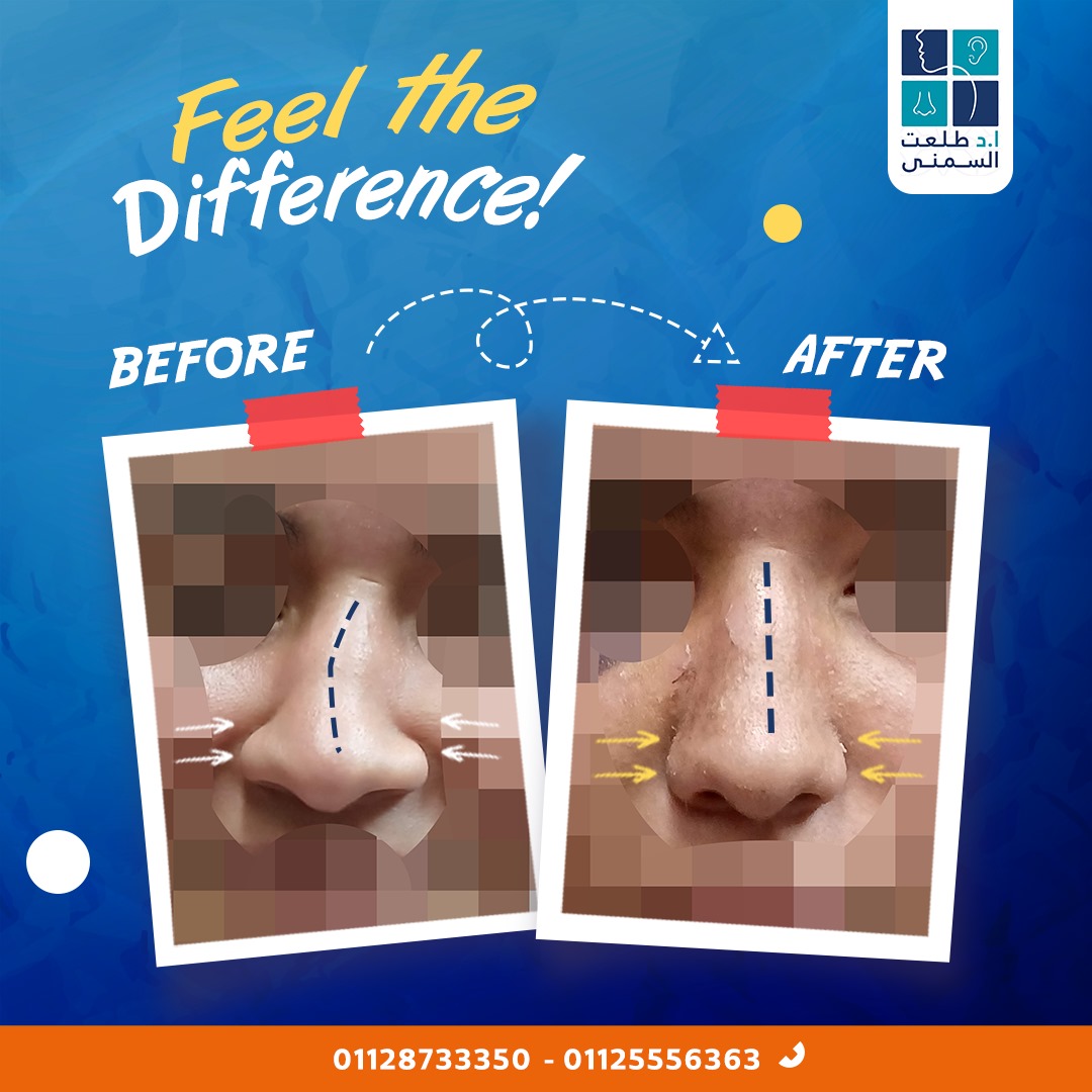 حالة قبل وبعد تجميل الأنف 2