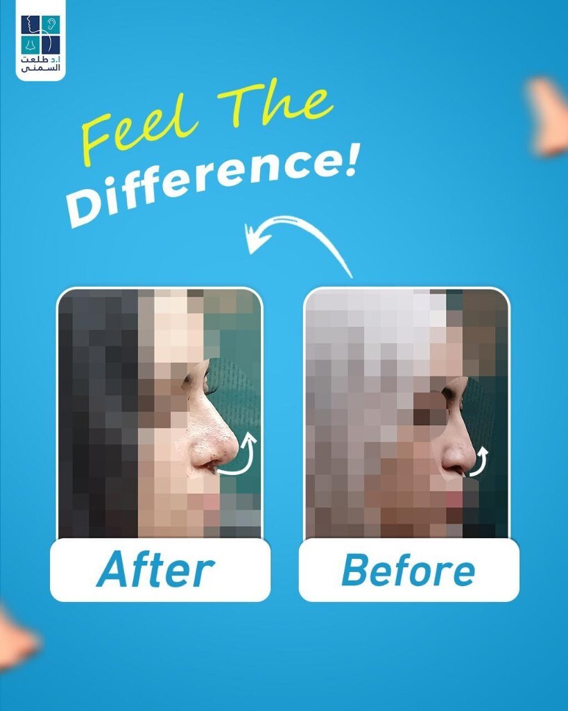 حالة قبل وبعد تجميل الأنف 14