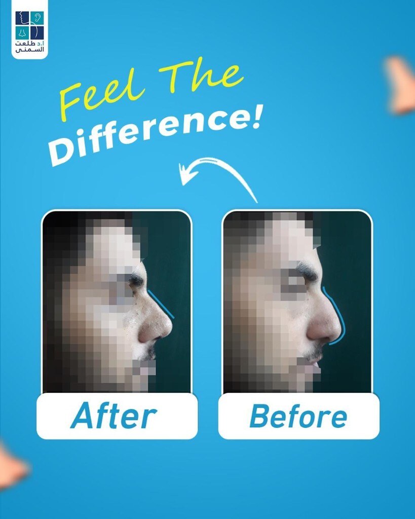 حالة قبل وبعد تجميل الأنف 16