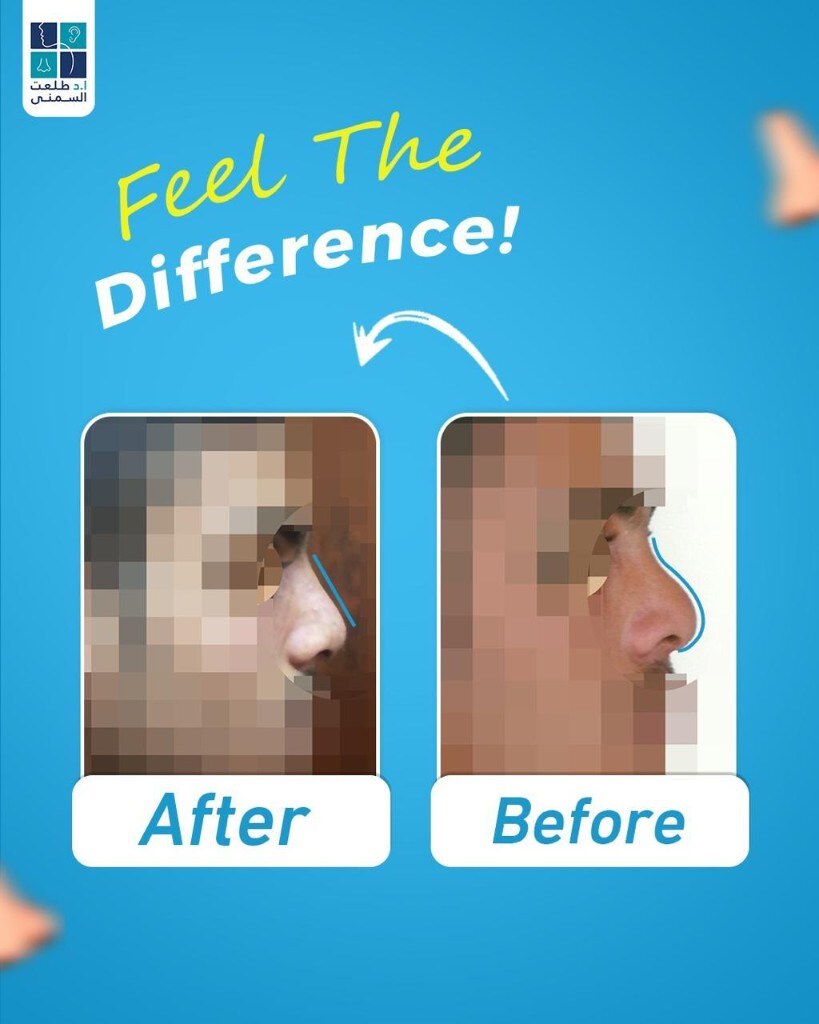 حالة قبل وبعد تجميل الأنف 17