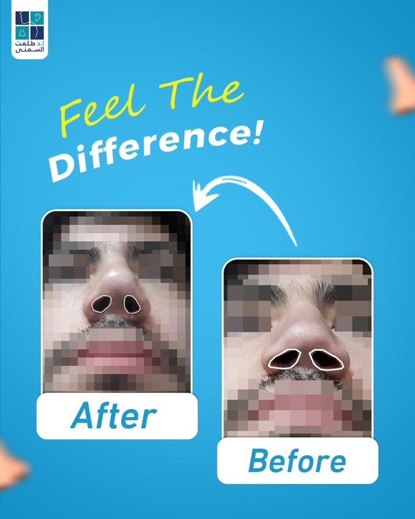 حالة قبل وبعد تجميل الأنف 18