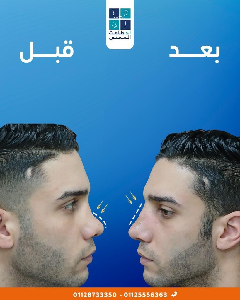 حالة قبل وبعد تجميل الأنف 19