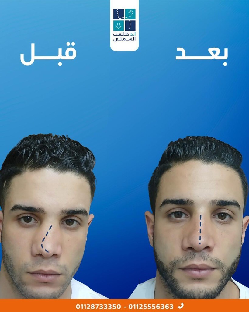 حالة قبل وبعد تجميل الأنف 20
