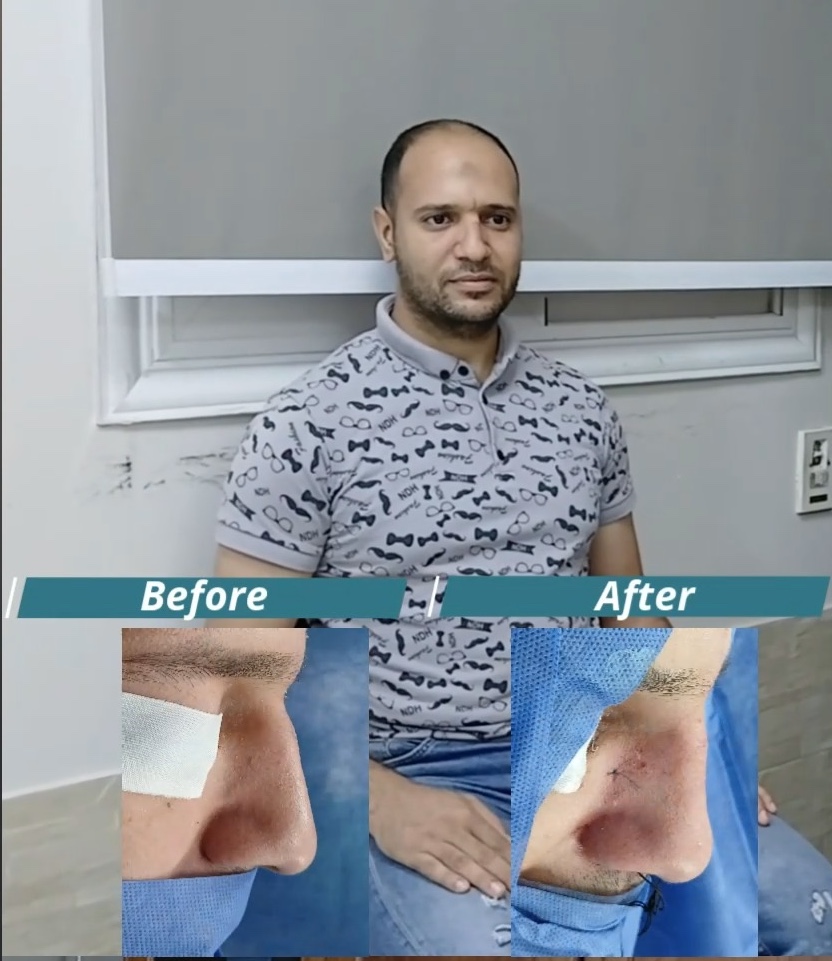 رأي مريض بعد عملية تجميل الأنف من فيسبوك