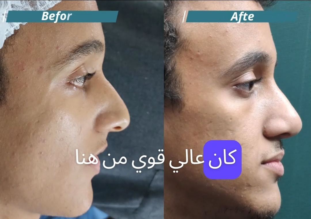 رأي مريض بعد عملية تجميل الأنف من فيسبوك