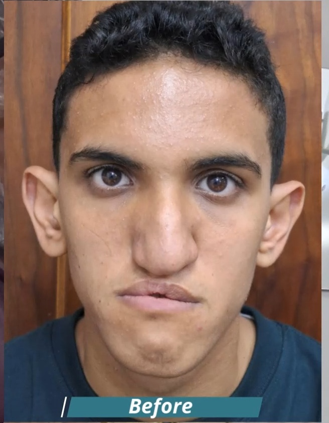 رأي مريض بعد عملية تجميل الأنف من فيسبوك