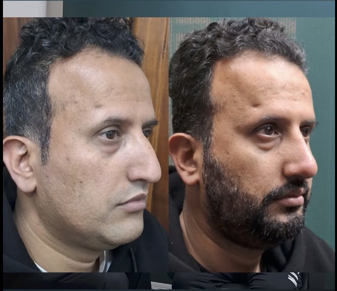 رأي مريض بعد عملية تجميل الأنف من فيسبوك