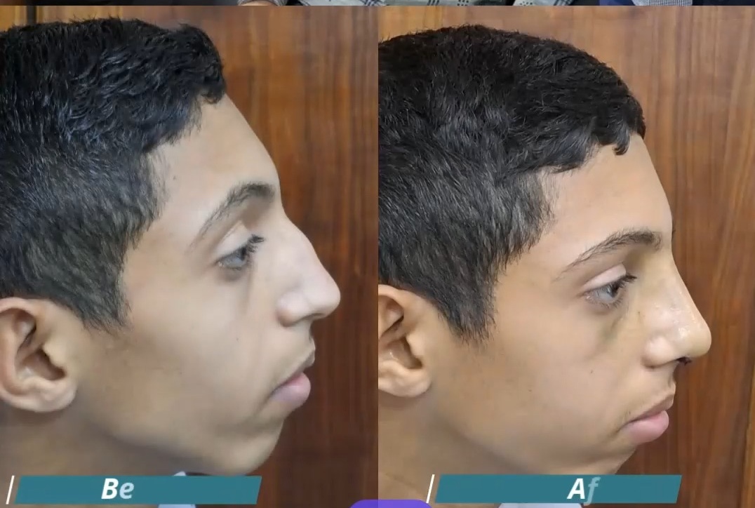 رأي مريض بعد عملية تجميل الأنف من فيسبوك