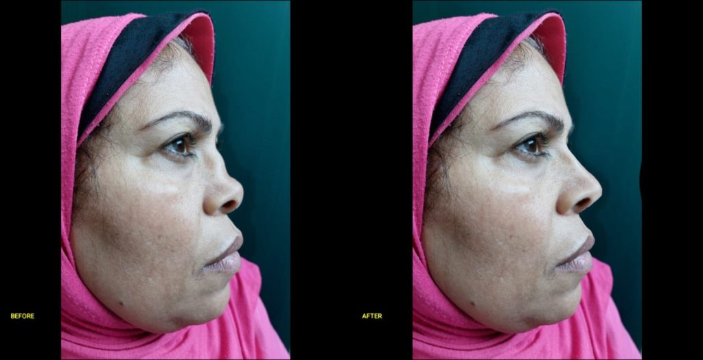 محاكاة الشكل المتوقع بعد تجميل الأنف