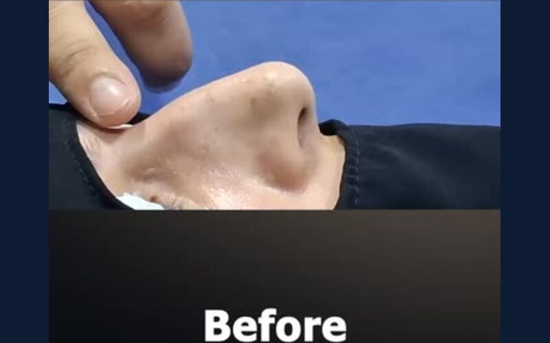 فيديو حالة قبل وبعد تجميل الأنف