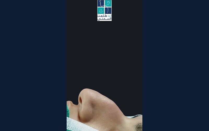فيديو حالة قبل وبعد تجميل الأنف
