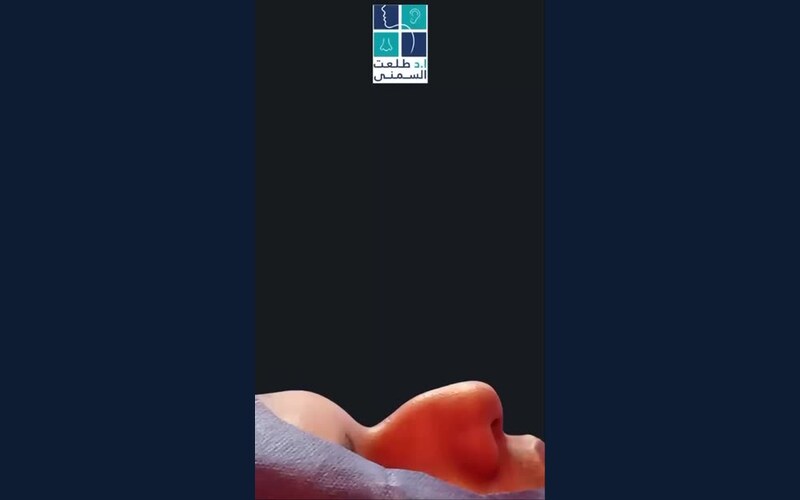 فيديو حالة قبل وبعد تجميل الأنف