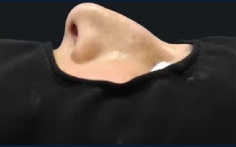 فيديو حالة قبل وبعد تجميل الأنف