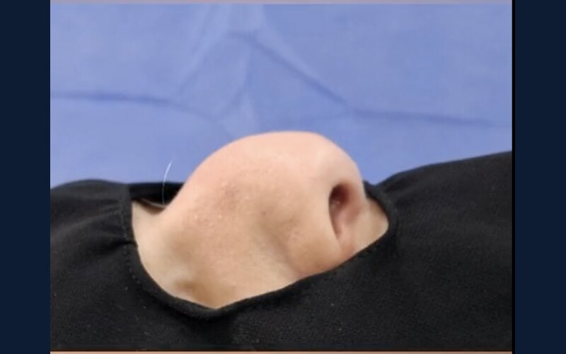 فيديو حالة قبل وبعد تجميل الأنف