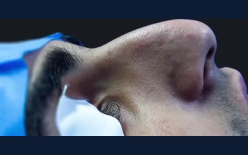 فيديو حالة قبل وبعد تجميل الأنف