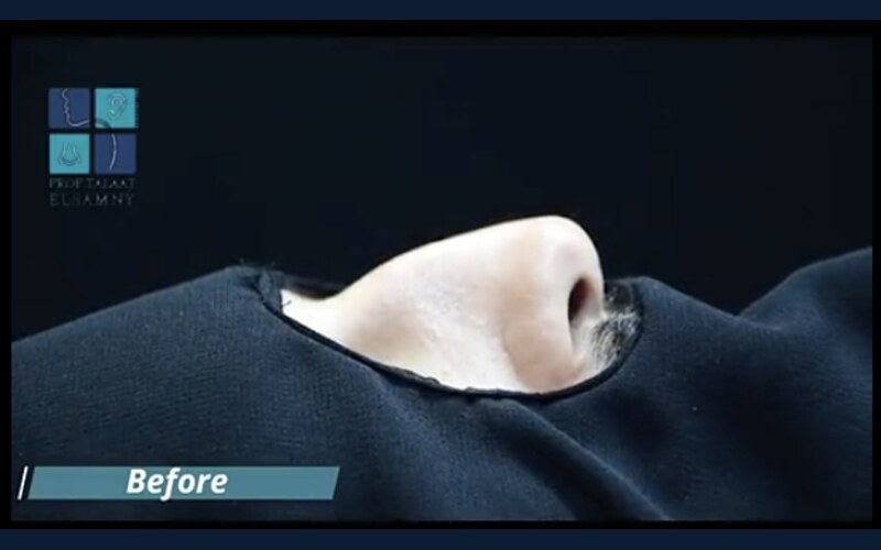 فيديو حالة قبل وبعد تجميل الأنف